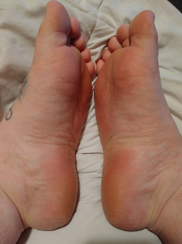 Week 3 of using Suzotic Hand and Foot Advanced Skin Care