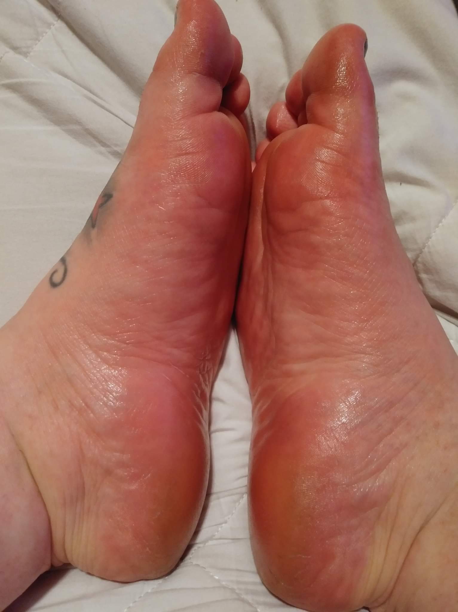 Week 2 of using Suzotic Hand and Foot Advanced Skin Care